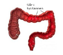 Kronisk betændelsestilstand i tarmen (colitis ulcerosa).PNG