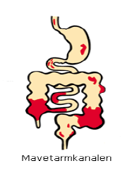 Kronisk betændelsestilstand i tarmen (morbus crohn).PNG