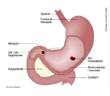 Sår i mavesækken eller tolvfingertarmen.PNG