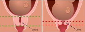 Cervix