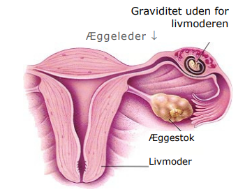 Graviditet som ikke kan ses på scanning - PUL.PNG