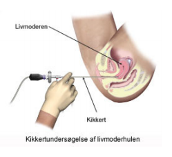 Kikkertundersøgelse af livmoderen i Klinik for Kvindesygdomme + dagkirurgien.PNG