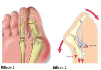 af storetåknyst (hallux valgus) - Regionshospitalet