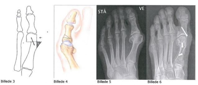 hallux valgus 2.JPG