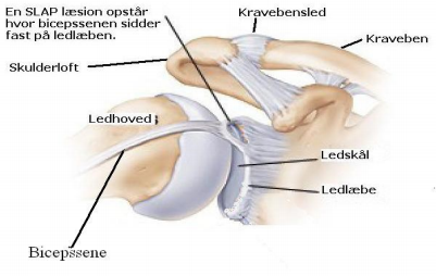 Ledlæbeskade i (SLAP-læsion) - Regionshospitalet Horsens