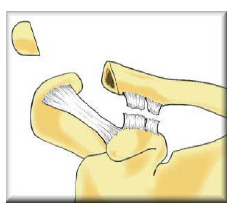 Overrivning af mellem kraveben og skulderblad (AC luksation) - Horsens