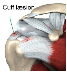 Rotator cuff læsion.PNG