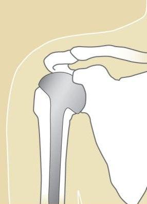Skulderprotese v. knoglebrud 2.jpg