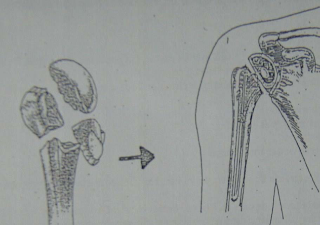 Skulderprotese v. knoglebrud 3.png