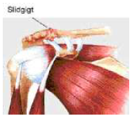 Slidgigt mellem kraveben og skulderblad.png